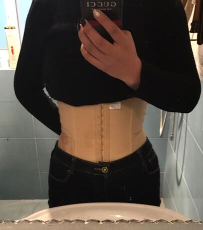 保定現(xiàn)代女子醫(yī)院整形美容中心做腰腹部吸脂怎么樣？附林秀蓮醫(yī)生案例效果圖