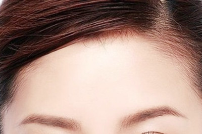 長沙亞韓醫(yī)學(xué)美容醫(yī)院自體脂肪豐額頭