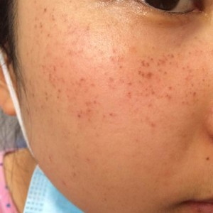 寶雞皮膚病醫(yī)院文東亮醫(yī)生做臉部祛斑效果怎么樣？附臉部祛斑案例