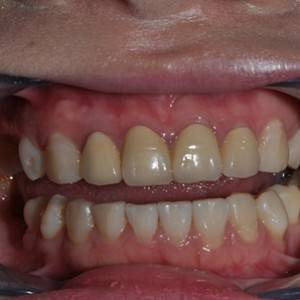 保定東陽口腔醫(yī)院張亞靜醫(yī)生做牙齒冷光美白怎么樣？附冷光美白案例效果對比圖