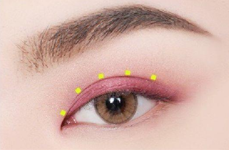 廈門(mén)華美名媛整形美容醫(yī)院雙眼皮