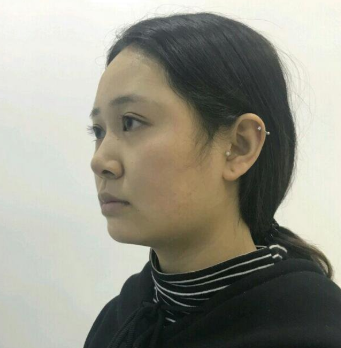 汕頭名流整形美容醫(yī)院假體隆下巴手術前效果