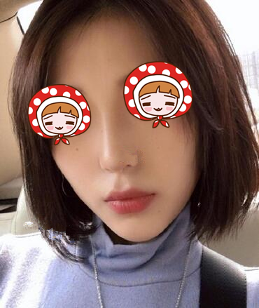 蘇州愛思特醫(yī)療美容醫(yī)院鼻骨矯正手術(shù)后的效果