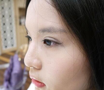 蘇州愛思特醫(yī)療美容醫(yī)院雙眼皮術(shù)后效果