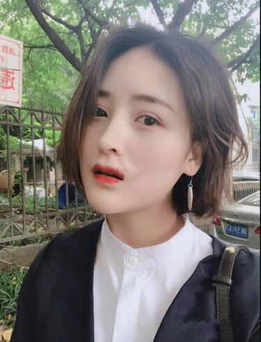 蘇州愛思特醫(yī)療美容醫(yī)院自體脂肪隆鼻手術后效果