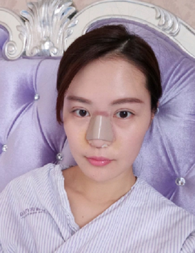 蘇州愛思特醫(yī)療美容醫(yī)院鼻翼縮小術(shù)前效果