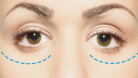 去眼袋失敗修復(fù)價(jià)格多少？去眼袋失敗修復(fù)方法？