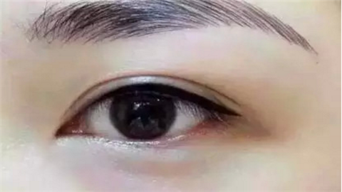雙眼皮埋線手術(shù)價格是多少？雙眼皮埋線能保持多長時間？