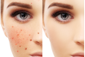 激光祛斑的一般價(jià)格是多少？