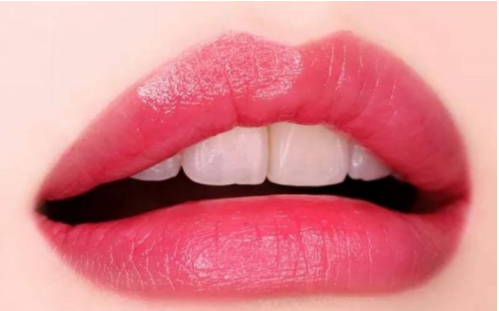 玻尿酸豐唇一般需要幾支呢？