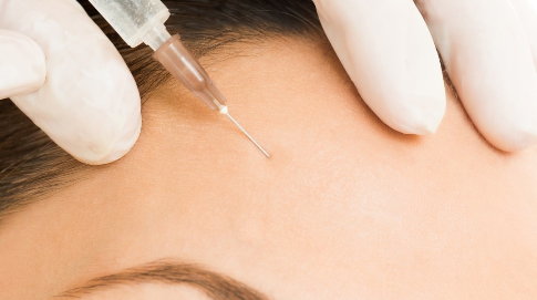 自體脂肪豐面頰的效果能維持多久？