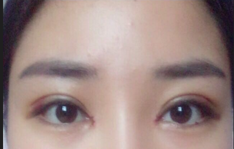 全切雙眼皮多少錢一次？全切雙眼皮后遺癥有哪些？