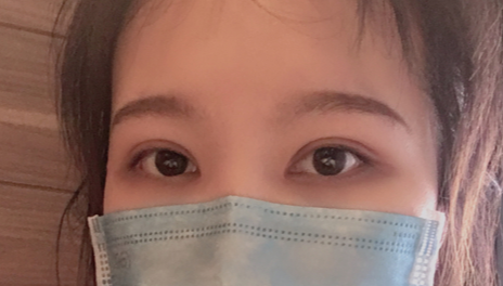 全切雙眼皮會越來越窄嗎？