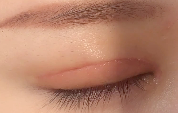 全切雙眼皮有哪些優(yōu)點？