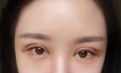 全切雙眼皮手術(shù)多少錢(qián)一次？