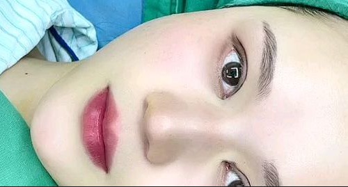 全切雙眼皮多長時(shí)間能恢復(fù)？