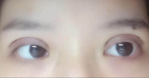 全切雙眼皮手術優(yōu)勢？