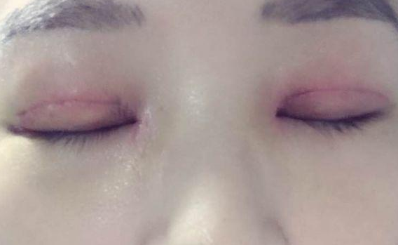 全切雙眼皮不對(duì)稱怎么辦？