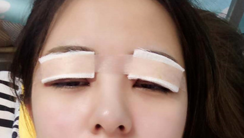 全切雙眼皮怎么恢復快？