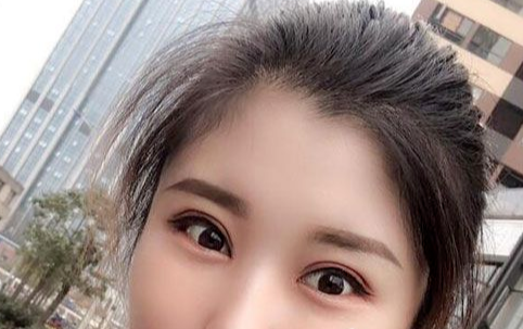 全切雙眼皮多長時間恢復(fù)自然？