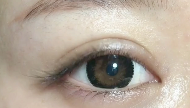 全切雙眼皮失敗可以修復嗎？