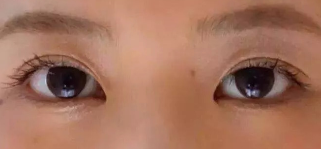 全切雙眼皮術(shù)后會(huì)疼幾天？