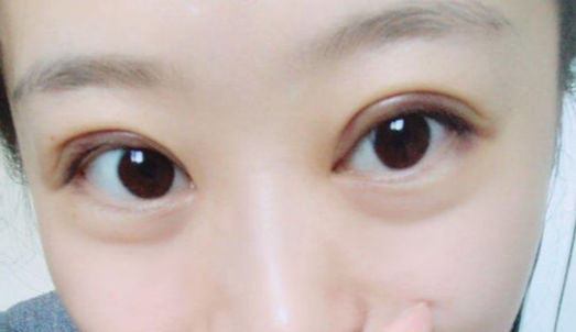 全切雙眼皮手術(shù)時(shí)間？全切雙眼皮術(shù)后會(huì)反彈嗎？