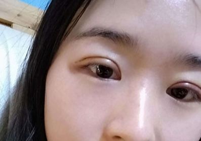 全切雙眼皮大概多少錢？