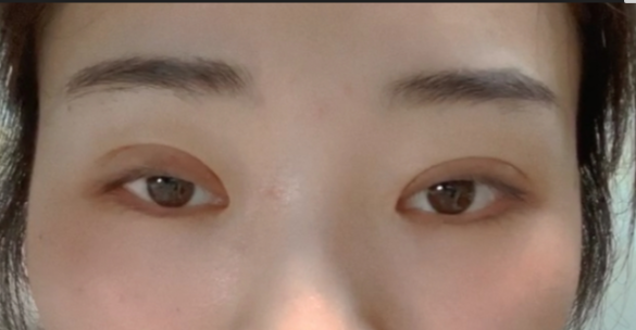 什么是全切雙眼皮？