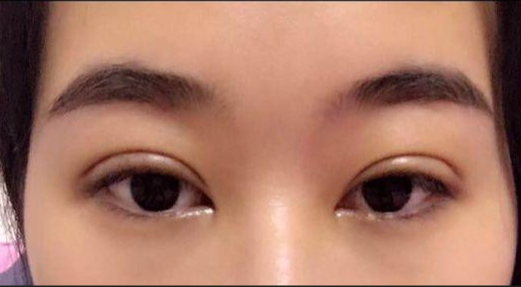 全切雙眼皮的危害有哪些？
