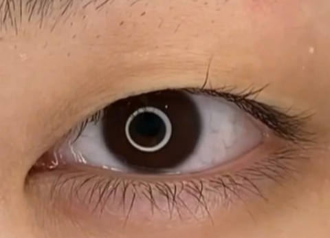 全切雙眼皮幾天可以洗臉？