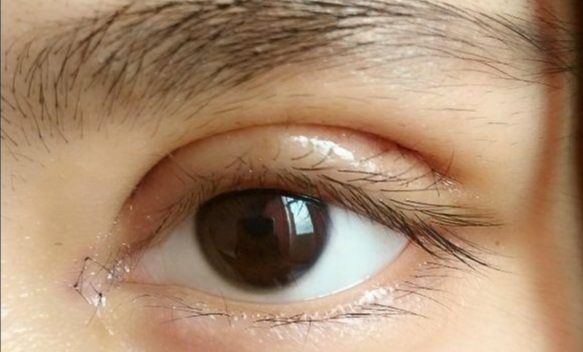 全切雙眼皮會留疤嗎？全切雙眼皮的優(yōu)缺點？