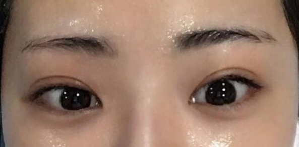 全切雙眼皮適合哪些人？