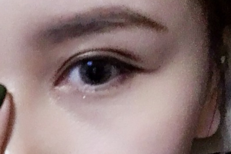 全切雙眼皮多久恢復(fù)好可以看到效果？全切雙眼皮需要多少錢(qián)？