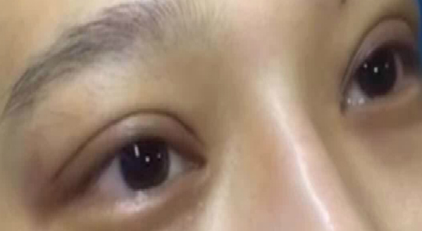 埋線(xiàn)雙眼皮大概能保持幾年？