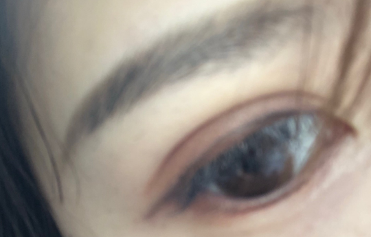 埋線雙眼皮手術(shù)優(yōu)勢有哪些？