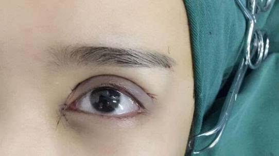 埋線雙眼皮會(huì)不會(huì)脫線？