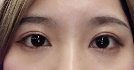 埋線雙眼皮幾天可以碰水？