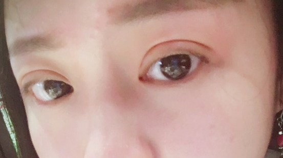 埋線雙眼皮可以保持幾年？埋線雙眼皮的危害有哪些？