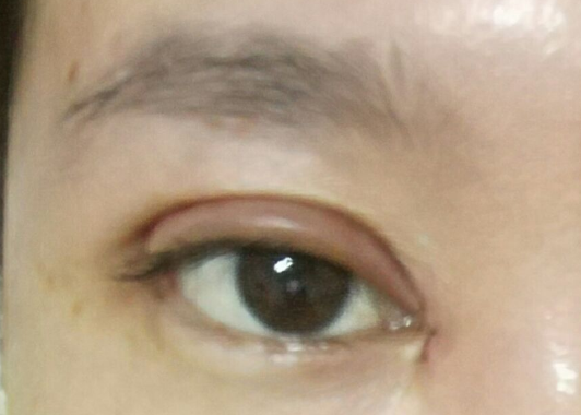 埋線雙眼皮可以維持幾年？