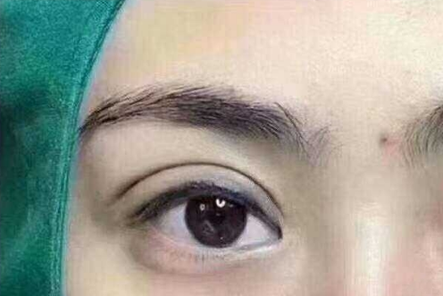埋線雙眼皮貴不貴？