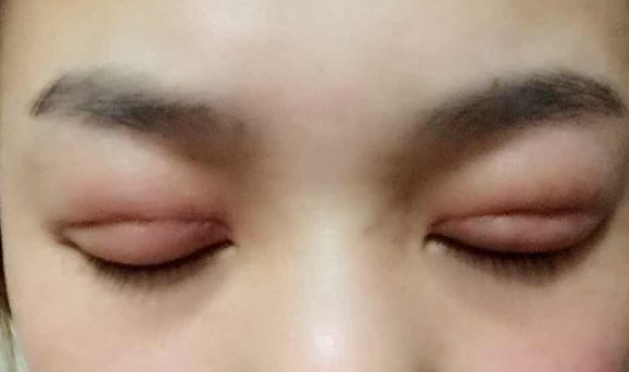 埋線雙眼皮幾天能消腫？