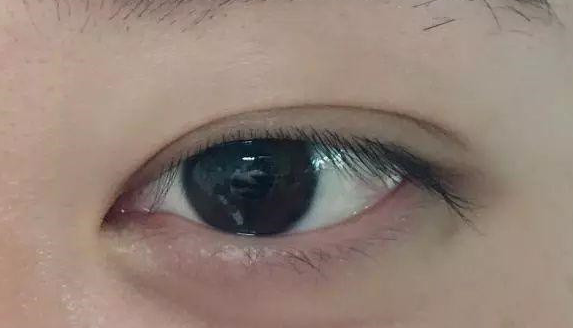 埋線雙眼皮有沒有危害？