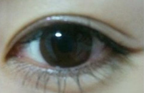 雙眼皮埋線怎么消腫快？埋線雙眼皮手術(shù)后有禁忌嗎？