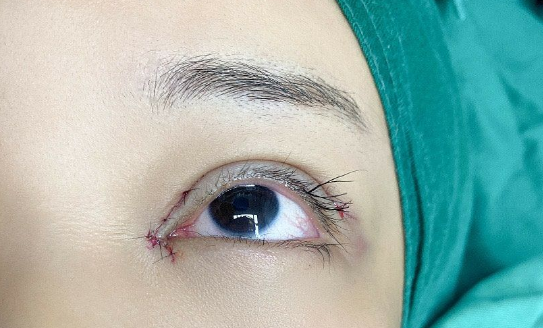 埋線雙眼皮消失怎么辦？