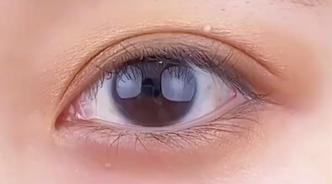 定點雙眼皮多少錢？雙眼皮定點好嗎？