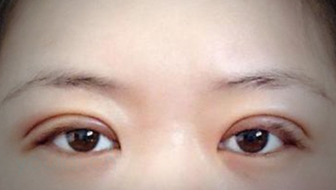 定點(diǎn)雙眼皮幾天能恢復(fù)好？定點(diǎn)做雙眼皮多少錢？