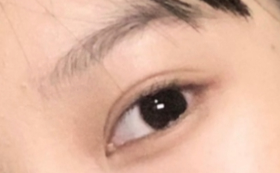 什么是雙眼皮定點？