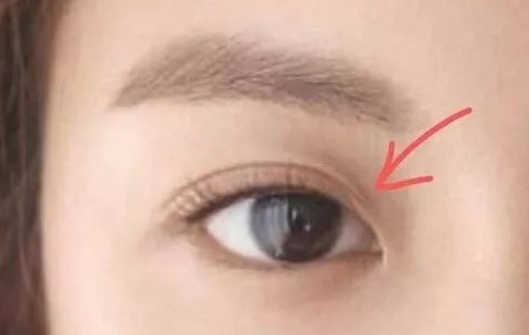 定點(diǎn)雙眼皮多久可以化妝？定點(diǎn)雙眼皮一般多少錢？