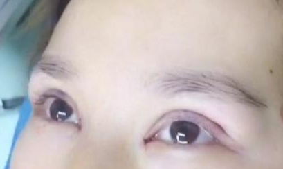 定點雙眼皮手術(shù)效果自然嗎？